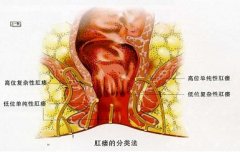 肛瘘手术疼吗